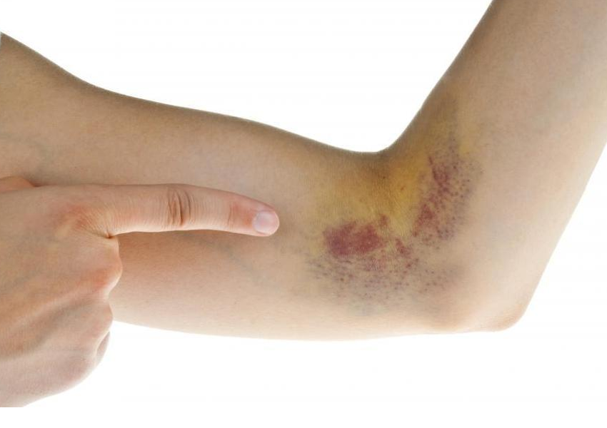 Vỡ mạch máu dưới da có nghiêm trọng không?