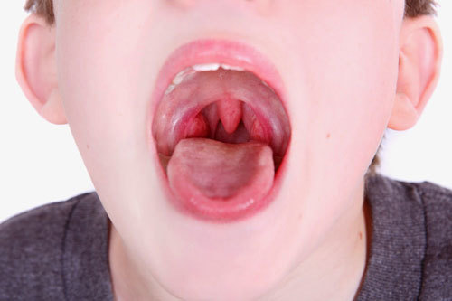 Triệu chứng khi trẻ mắc phải bệnh viêm họng cấp