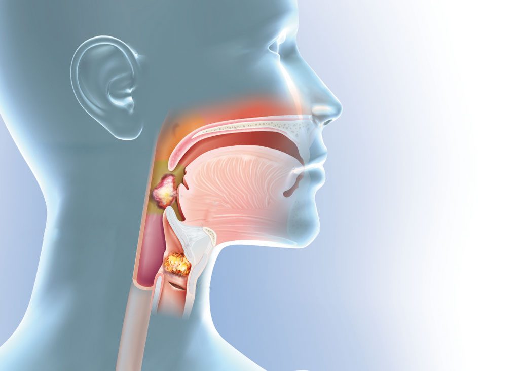 Dịch mũi chảy xuống họng là bệnh gì?