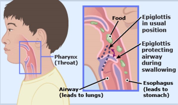 Dị vật đường thở là gì? Cách sơ cứu khi trẻ ngạt thở